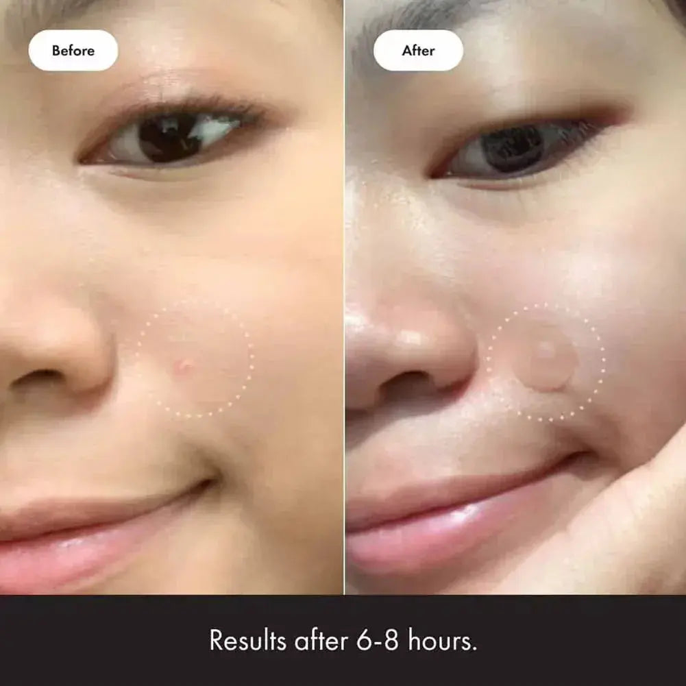 Hero Mighty Patch Hydrocolloid Acne Patches (72 Count) - BEAUXUS